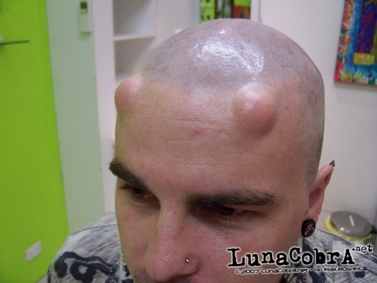 Implants Implants