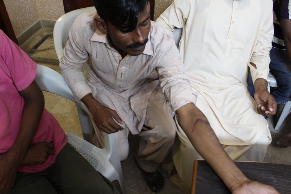 A worker shows the mark of severe cut he had received while working on H&M products.
