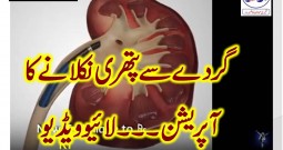 REMOVAL OF KIDNEY STONES new effective process